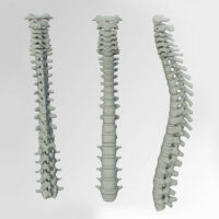 herniated disc can be treated at pinnacle physical therapy